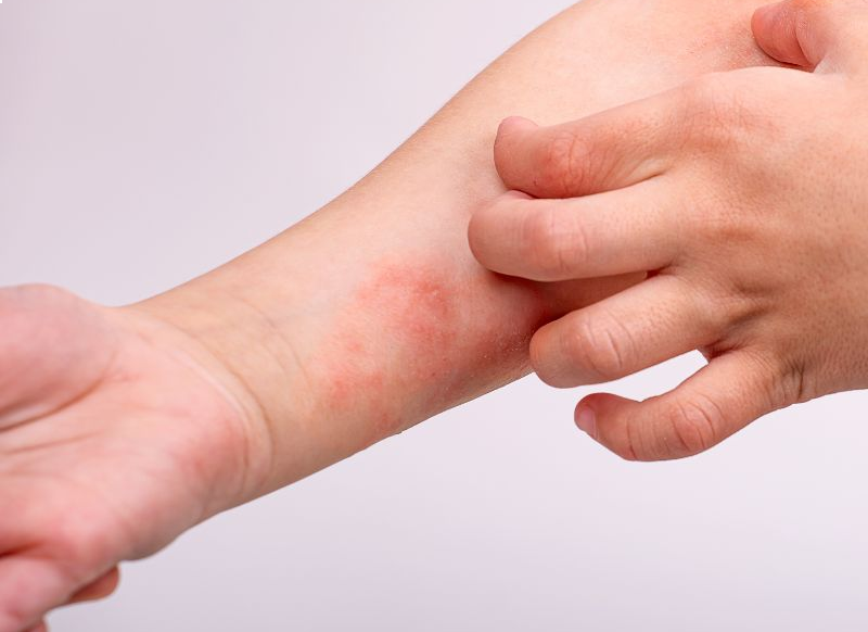 Atoopiline dermatiit, psoriaas või lihtsalt kuiv nahk? Kuidas leevendada naha sügelust ja taastada naha tasakaal? I Kidsmed