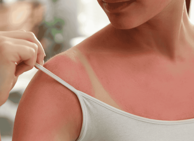 Mis toimub meie nahaga, kui me saame päikesepõletuse? I Kidsmed