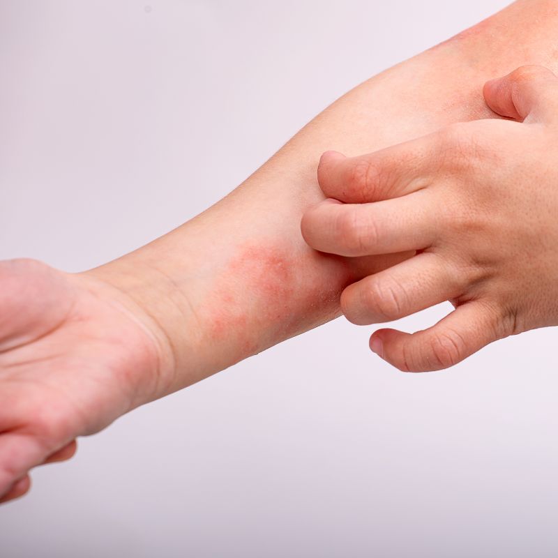 Atoopiline dermatiit, psoriaas või lihtsalt kuiv nahk? Kuidas leevendada naha sügelust ja taastada naha tasakaal? I Kidsmed